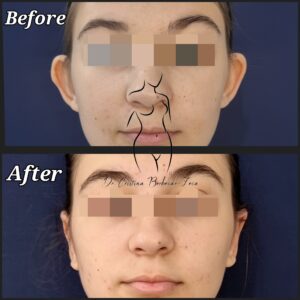 otoplastie
