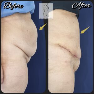 abdominoplastie