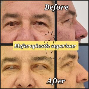 blefaroplastie, chirurgia pleoapelor