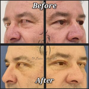 blefaroplastie, chirurgia pleoapelor