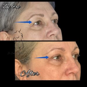 blefaroplastie superioara, chirurgia pleoapelor