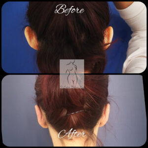 otoplastie
