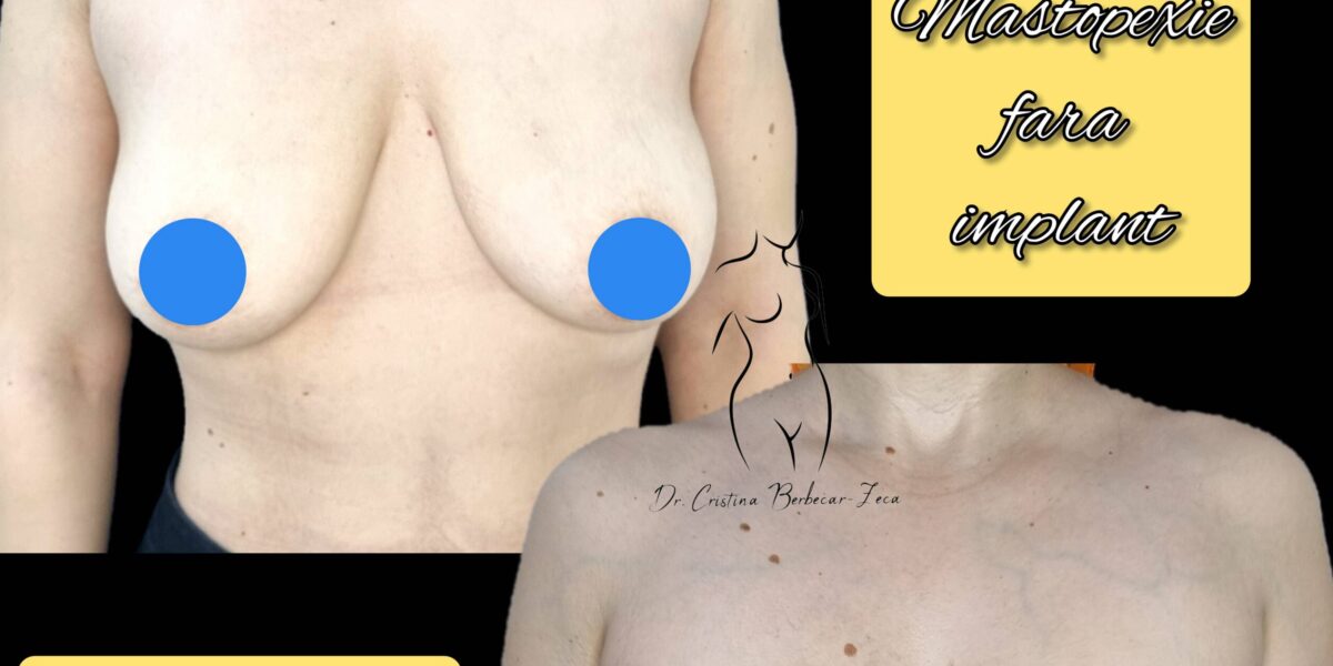 mastopexie fara implant