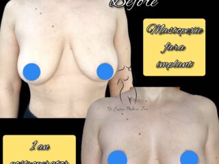 mastopexie fara implant