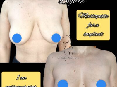 mastopexie fara implant